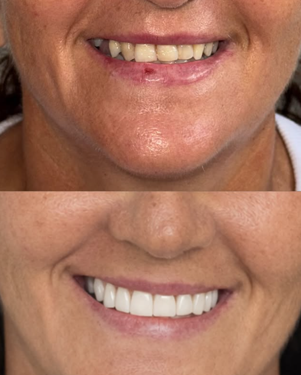 Antes e depois — Reabilitação estética