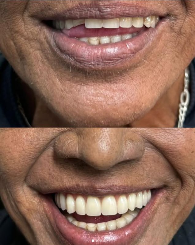 Antes e depois — Transformação do sorriso