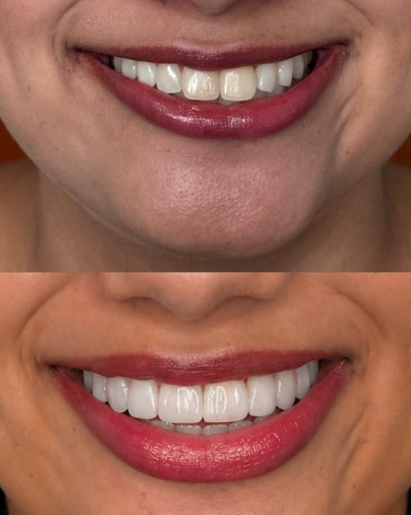 Antes e depois — Lentes dentais