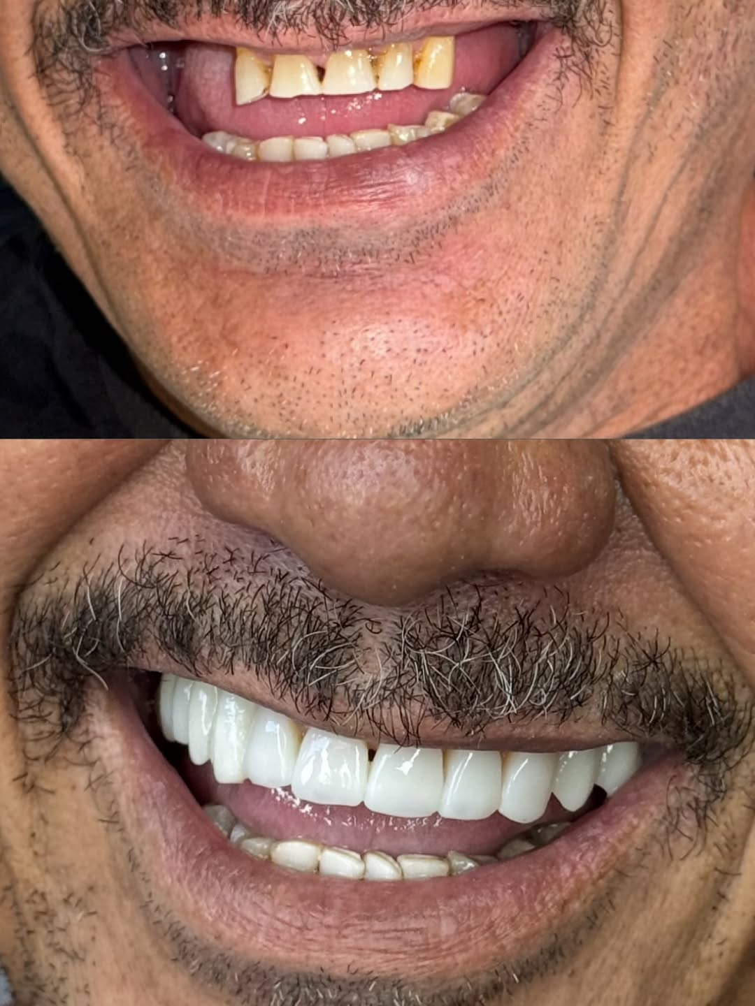 Antes e depois — Reabilitação com implantes